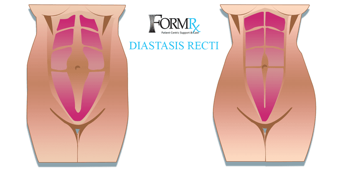 Diagram of abdominal separation, diastasis recti