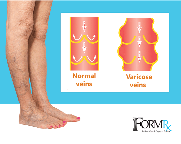 FormRx diagram comparing normal leg veins with varicose veins